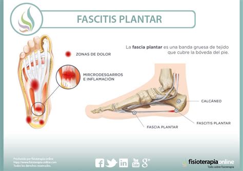 Fascitis plantar Qué es cuáles son sus causas y cómo podemos tratarla