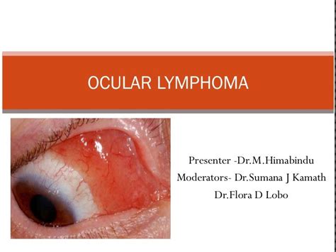 Ocular Lymphoma