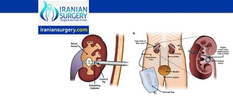 Ureteral Stenting And Nephrostomy Procedure In Iran Iranian Surgery