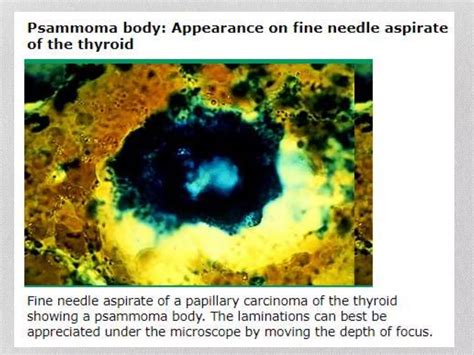 Approach To Thyroid Nodule Ppt