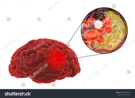 ischemic brain stroke treatment prevention concept stock illustration