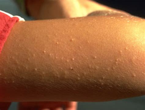 Skin Colored Bumps On Arms