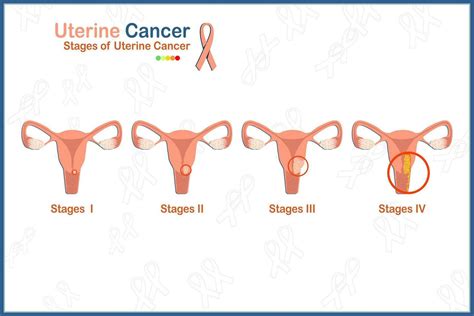 Flat Medical Vector Illustration Concept Of 4 Stages Of Uterine Cancer On White Background