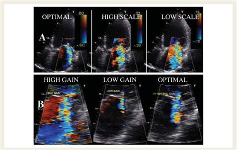 Effect Of Colour Scale A And Gain Setting B On Mitral Regurgitant Download Scientific