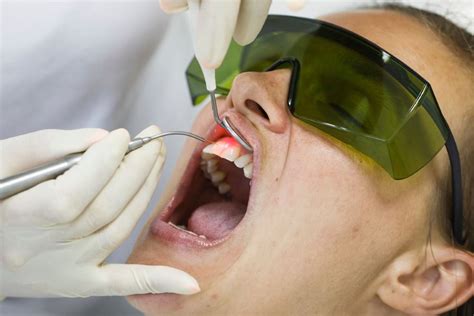 Пародонтоз Фото Лечение — Фото Картинки