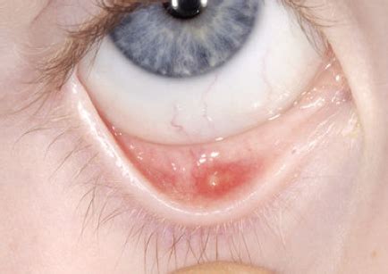 Chalazion