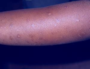 Hiv Rash Inside The Clinic