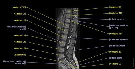 Columna Lumbar Irm Anatomía Normal E Anatomy