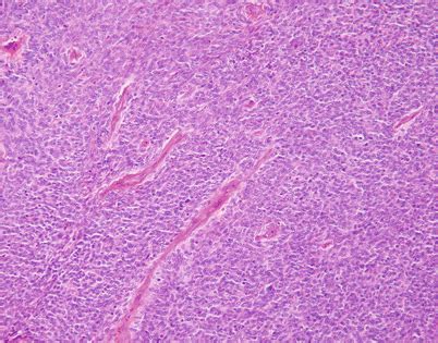 Soft Tissue Tumors of the Mediastinum | Basicmedical Key