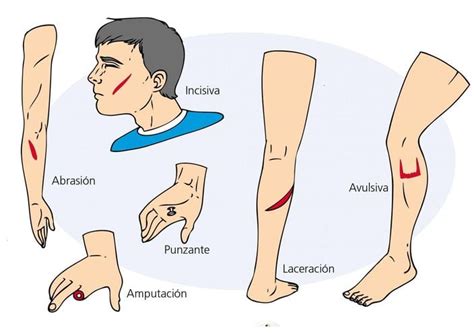Enfermería Básica: Heridas