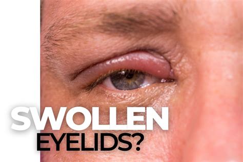 Seborrheic Blepharitis Treatment