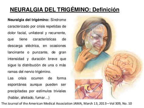 Neuralgia Del Trigemino