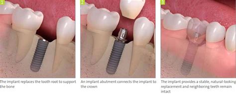 Missing Multiple Teeth Dental Implants Center In Brooklyn Ny