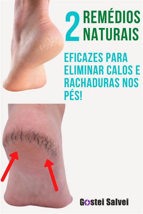 Qual O Melhor Calçado Para Evitar Rachaduras Nos Pés - 2 Remédios naturais eficazes para eliminar calos e rachaduras nos pés ...