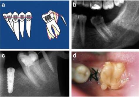 Molar Uprighting Techniques