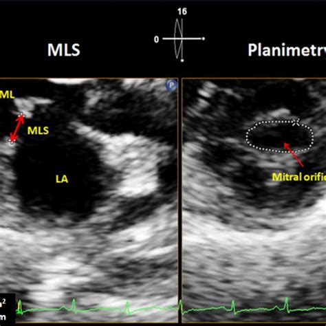 Simultaneous Display Of Parasternal Long Axis Plax And Parasternal