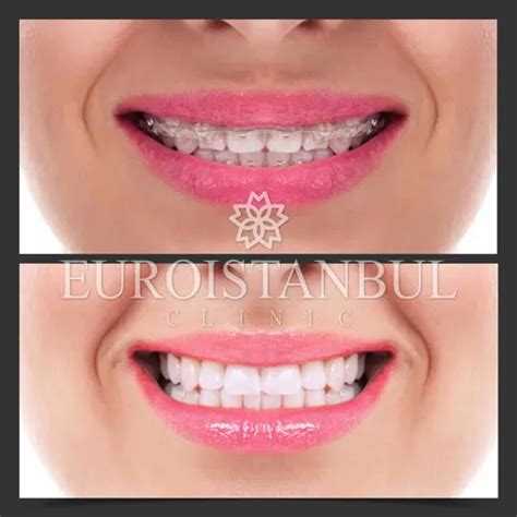 Teeth Whitening Price In Turkey Cost Euro Istanbul Clinic