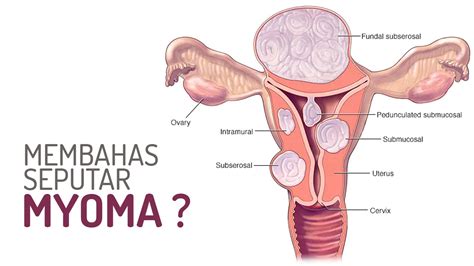 Terapi Pengecilan MYOMA Dengan Metoda ABLASI RADIOFREKUENSI RFA