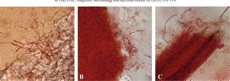 Figure From Diagnosis Of Dermatophytosis An Evaluation Of Direct