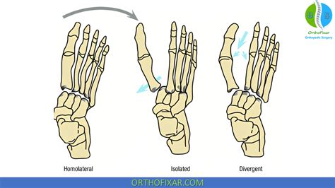 Lisfranc Fracture OrthoFixar 2024