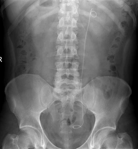 Ureteric Stent Radiology At St Vincents University Hospital