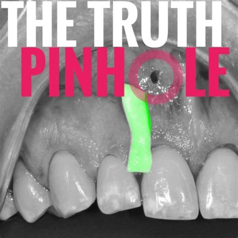 The Truth About Pinhole®️ Gum Grafting Advantages And Limitations