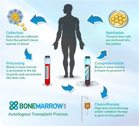 Types Of Bone Marrow Transplant Shifa International Hospital