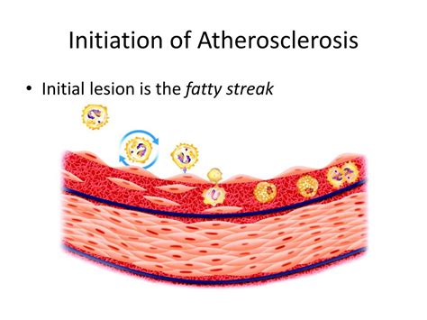 Ppt Atherosclerosis Powerpoint Presentation Free Download Id 5689756