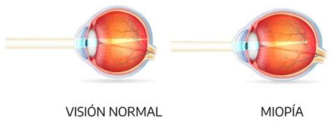 Qué es la MIOPÍA Área Oftalmológica Avanzada