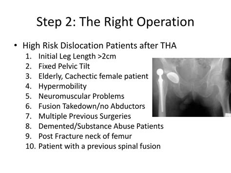 Ppt Primary Total Hip Arthroplasty Powerpoint Presentation Free Download Id 3040109