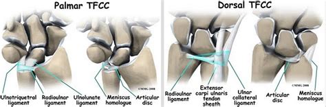 Tfcc Injury Hand Orthobullets