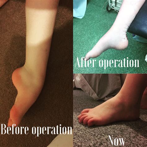 What many people don t know about my charcot marie tooth disease – Artofit