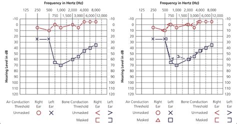 Types Of Tests For Hearing Loss Audiology Island