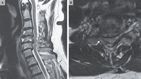 Degenerative Cervical Spondylosis | NEJM