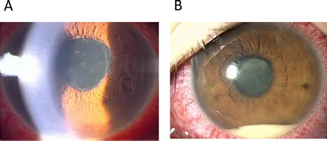 Anterior Uveitis