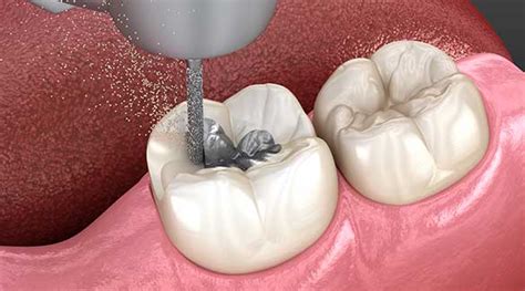 Safe Amalgam Removal Dentram Dental Clinics