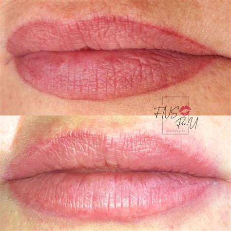 Non Laser Tattoo Pmu Removal Face Naked Studio