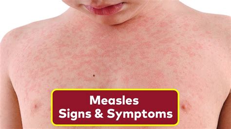 The 3 Warning Signs Of Measles To Look Out For How To Spot Measles