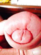 Huge Swollen Foreskin Brutal Pump Severe Bruising Porn Pictures XXX