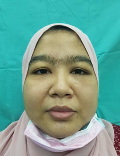 A Reduced Palpebral Aperture And Mild Enophthalmos Of The Left Eye As