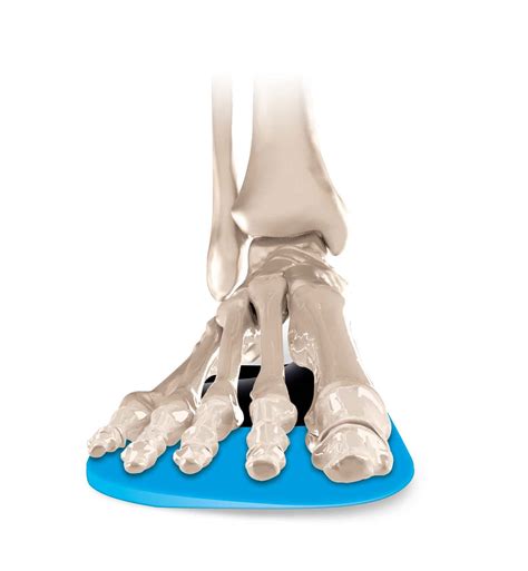 Valgus Extension Kevinroot Medical