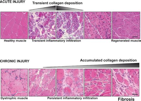 Extracellular Matrix Ecm Deposition In Acute And Chronic Muscle