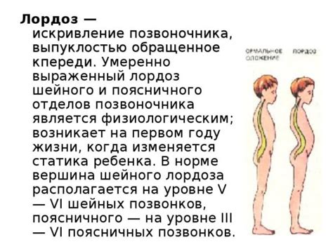 Статья про Что такое гиперлордоз поясничного отдела позвоночника с ...