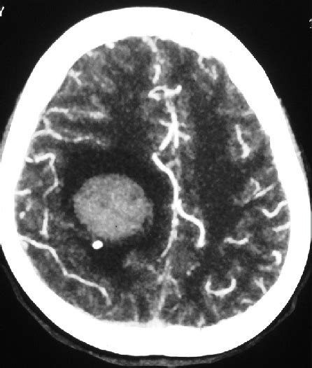 Computed Tomography Scan Of The Brain Shows A Space Occupying Lesion In