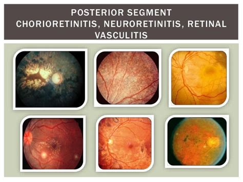 Ocular manifestations of syphilis