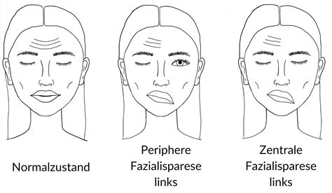 Fazialisparese Gesichtslähmung Symptome Formen Behandlung