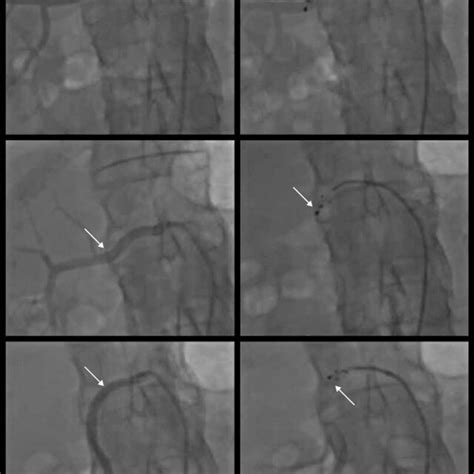 B – renal denervation procedure performed in 3 separate renal arteries ...