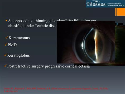 Mastery Of Holcomb C3 R Crosslinking For Keratoconus And Other Disorders For Patients And Physicians 1