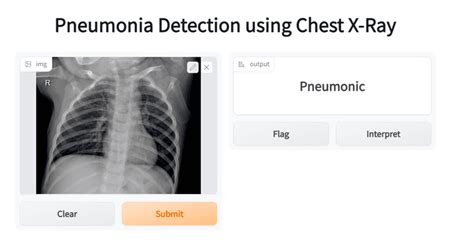 Pneumonia Detection Using Chest X Ray Devfolio