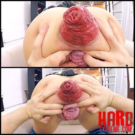 Argentina Naked Huge Anal Prolapse Huge Uterus Prolapse Brutal Pussy And Anal Fisting